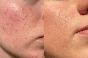 Close-up of acne-prone skin with CeraVe Acne Control Cleanser, promoting clearer skin.