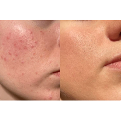 Acne Control & Blemish Control Bundle.